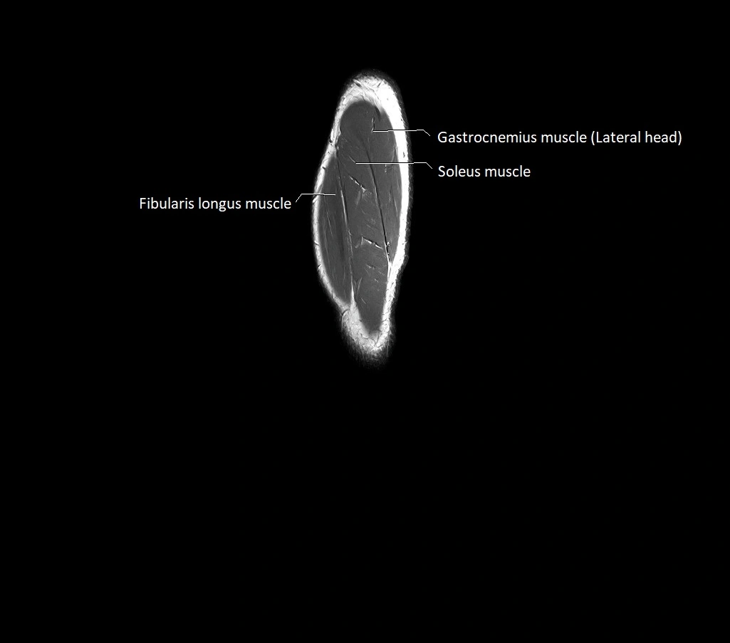 Lower leg sagittal anatomy 3T MRI image 2.webp